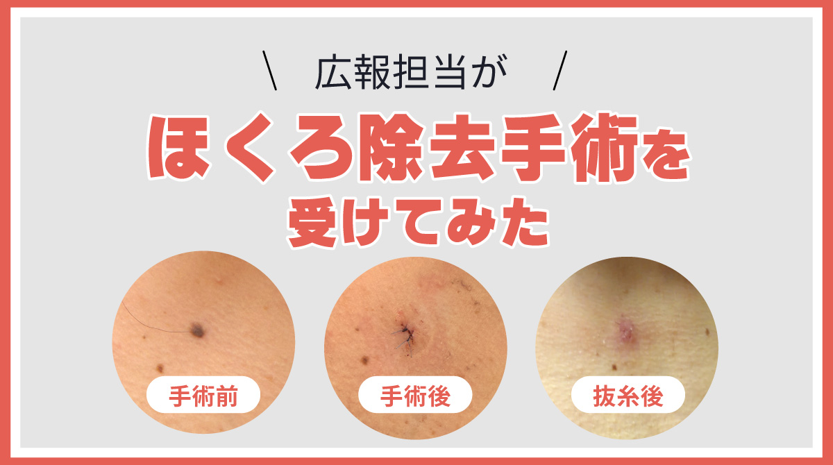 広報担当がほくろ除去手術を受けてみた